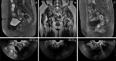 Superficial vaginal myofibroblastoma with mushroom-like appearance: A case report with colposcopic findings and literature review